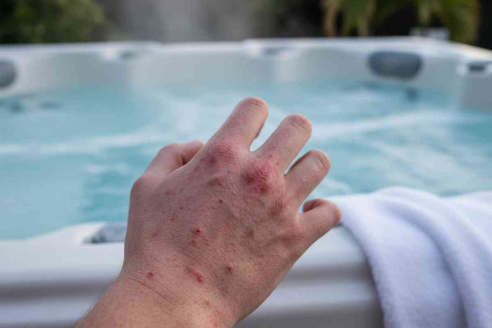 Itchy Skin After Hot Tub Use