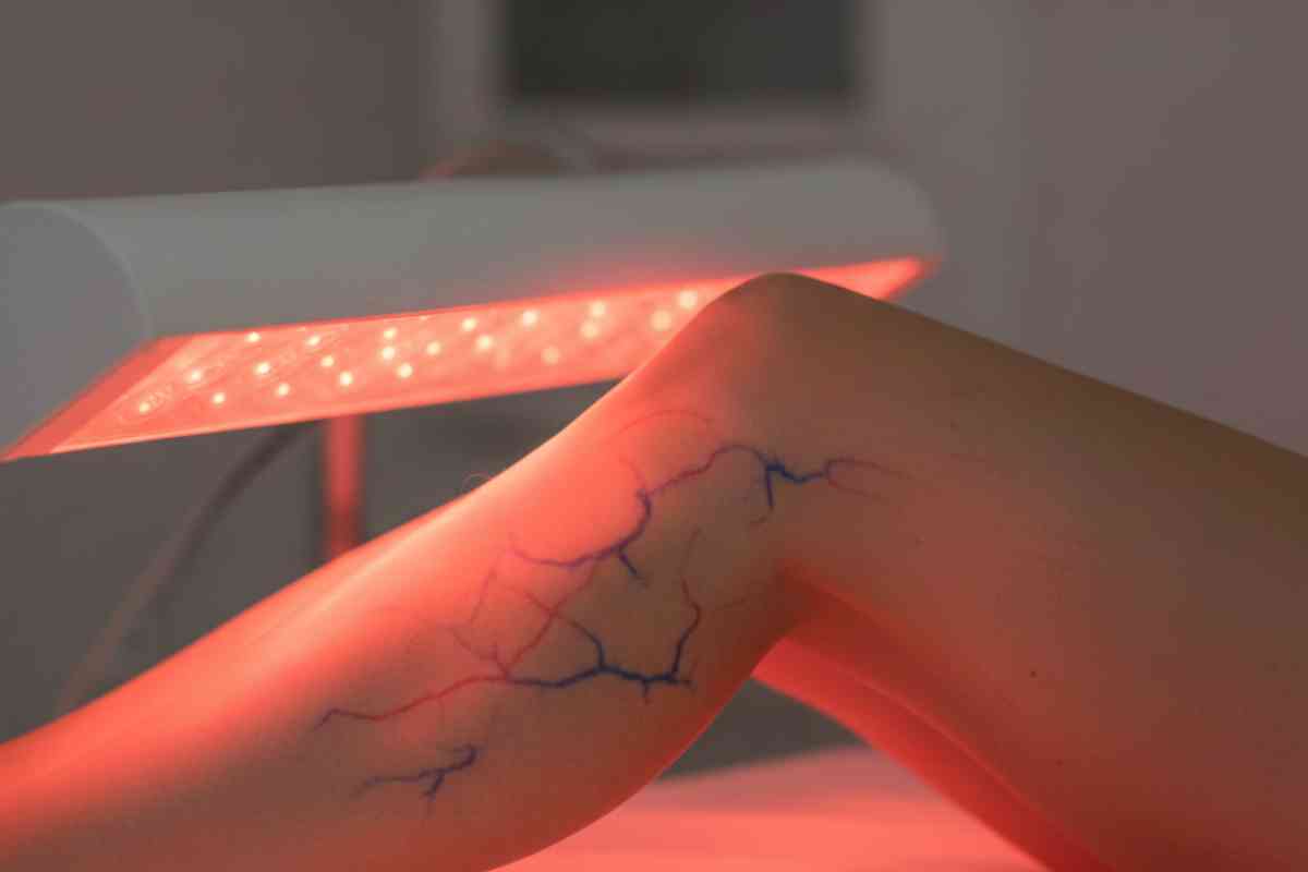 5 Reasons Red Light Therapy May Help with Spider Veins