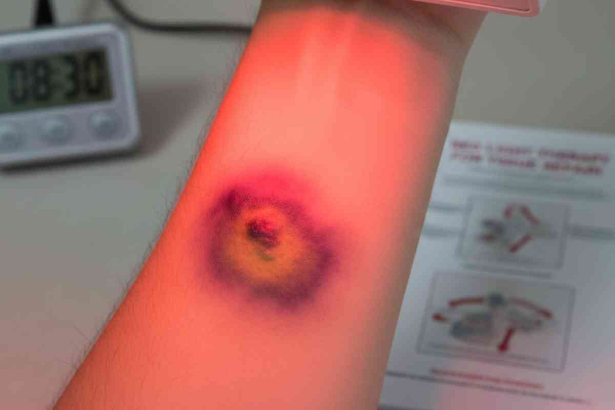 Can Red Light Therapy Speed Up Bruise Healing