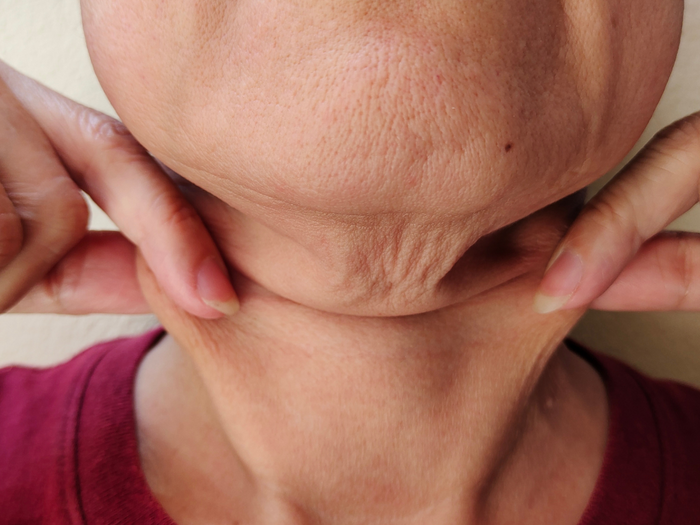 Does red light therapy help sagging skin?